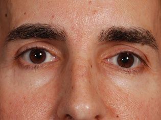 Male Patient's Eyes and Nose Before Injectable Fillers