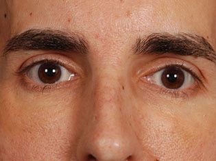 Male Patient's Eyes and Nose After Injectable Fillers