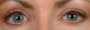 Patient With Blue Eyes Before Latisse Treatment