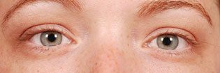 Patient With Light Eyes Before Latisse Treatment