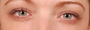 Patient With Light Eyes After Latisse Treatment