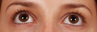 Patient With Brown Eyes Before Latisse Treatment