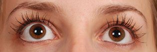 Patient With Brown Eyes After Latisse Treatment