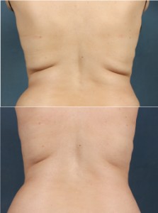 CoolSculpting Louisville