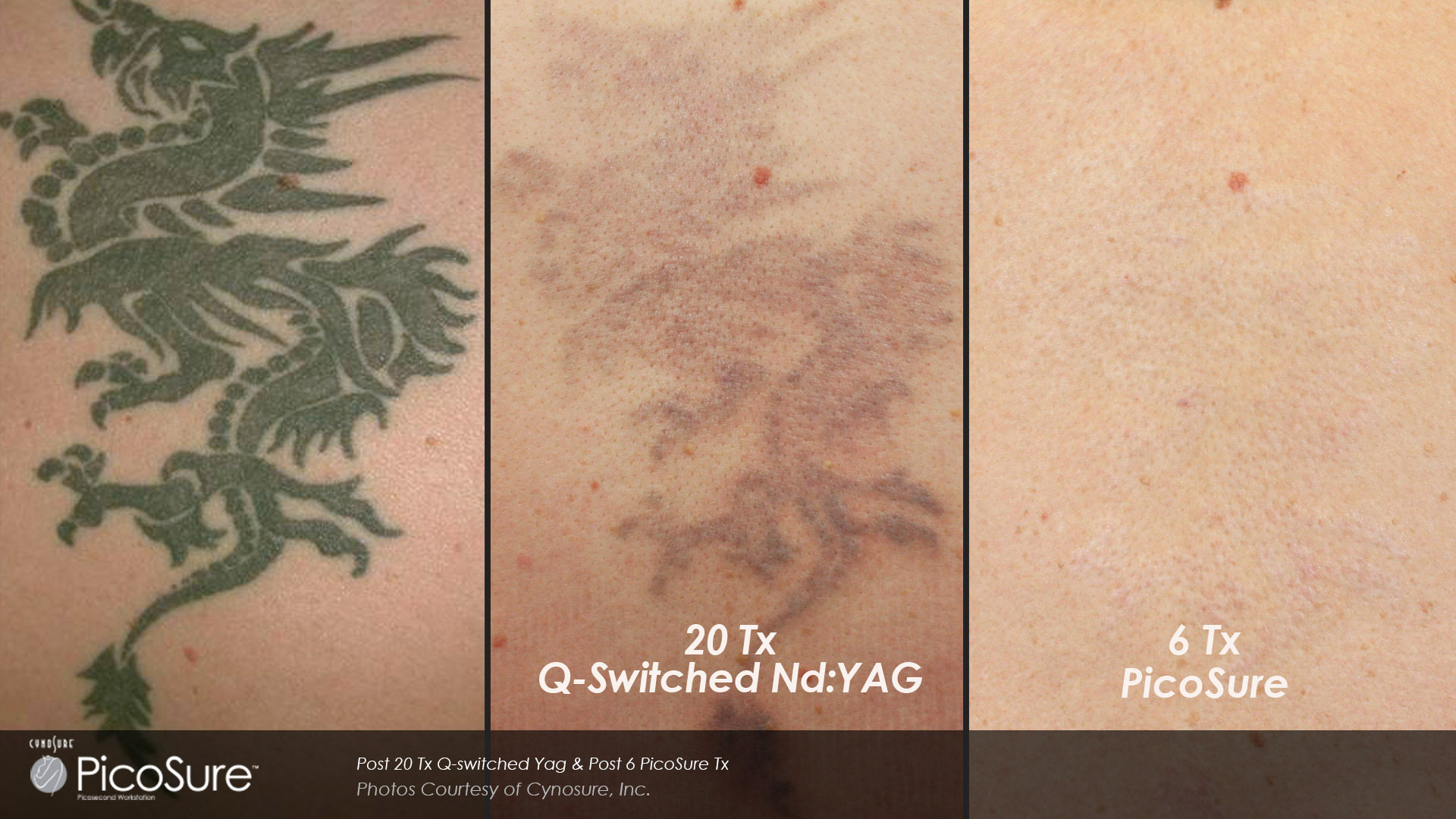 Laser Tattoo Removal - Lakeside Laser Clinic