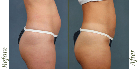 CoolSculpting before-and-after images in Lexington, KY.