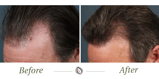NeoGraft® Hair Restoration: What to Expect | CaloSpa