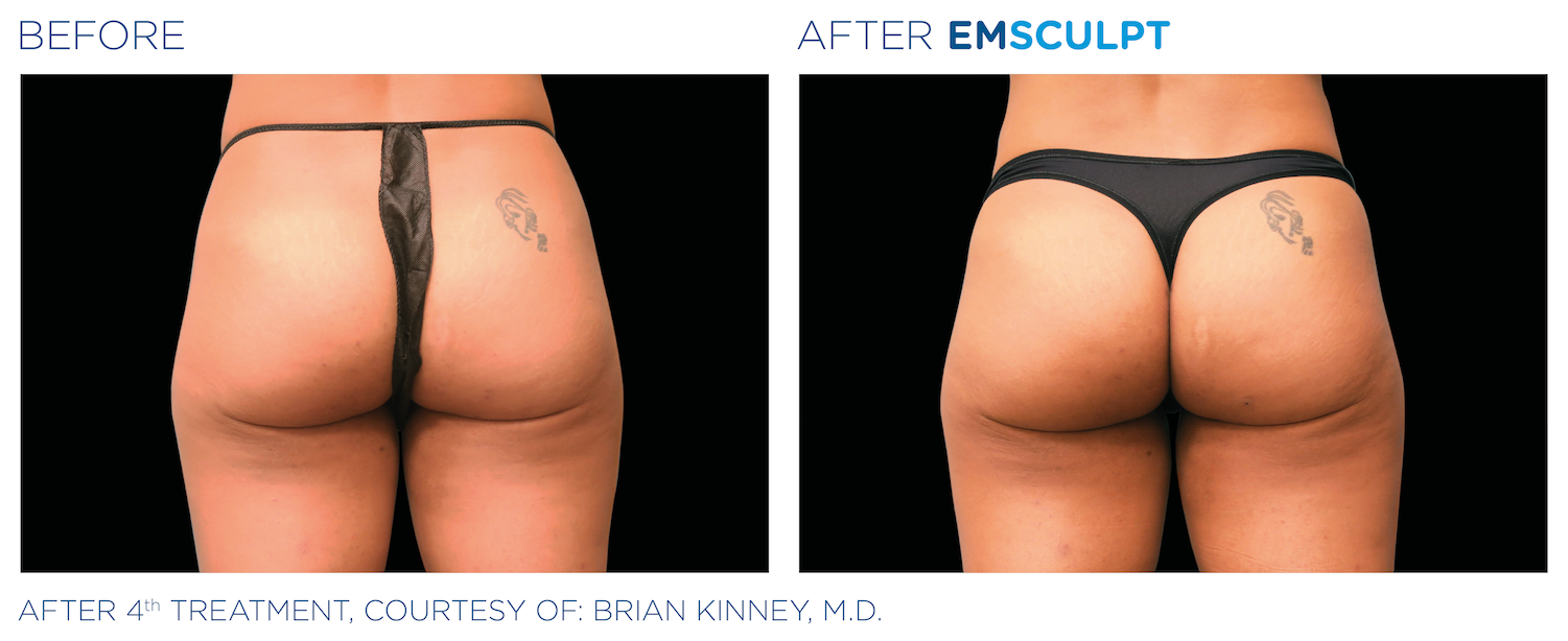 Emsculpt before and after picture