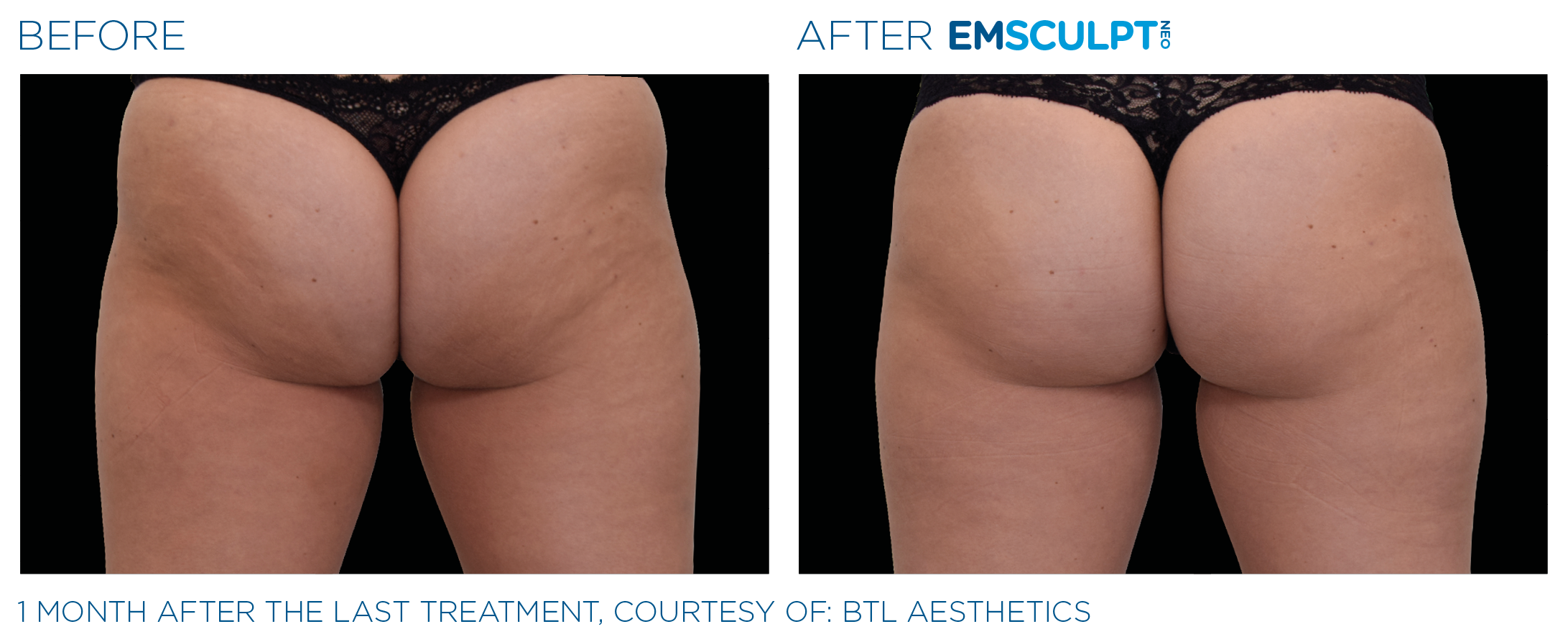 before and after of women's buttocks with emsculpt