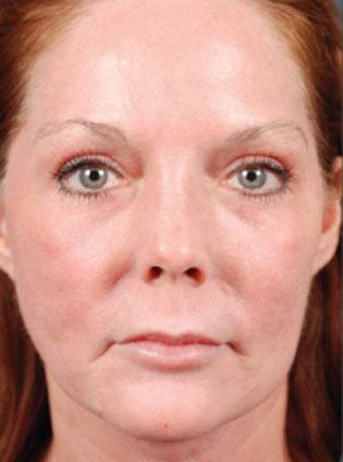Red Haired Woman After Fraxel Re:Pair