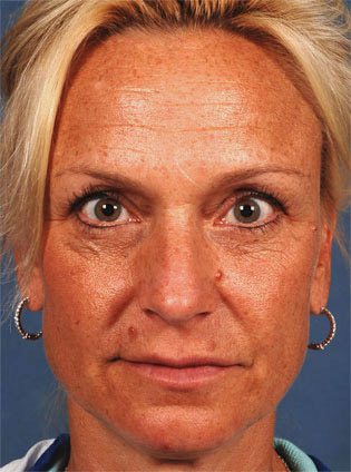 Blonde Woman Before Fraxel Re:Pair