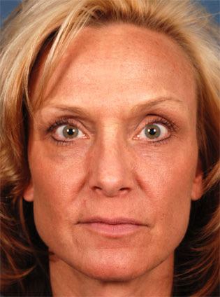 Blonde Woman After Fraxel Re:Pair