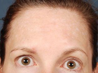 Brunette Woman After Fraxel Re:Pair