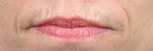 Injectables Patient Lips Before Treatment