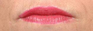 Injectables Patient Lips After Treatment