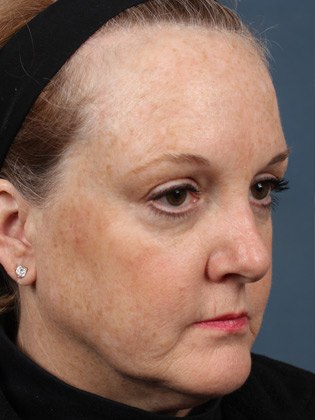 Front Side View of Woman's Face Before Injection Treatment