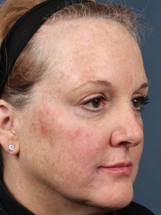 Front Side View of Woman's Face After Injection Treatment