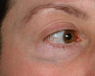 Vein Laser Treatment Patient Eye Before Treatment