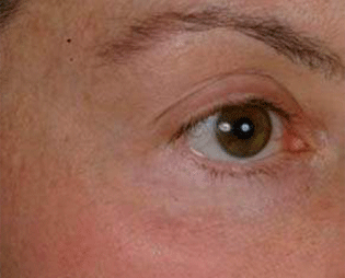 Vein Laser Treatment Patient Eye After Treatment