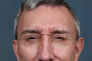 Male Patient Face and Forehead Before Wrinkle Treatment