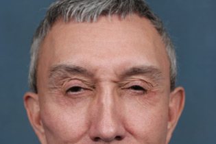Male Patient Face and Forehead After Wrinkle Treatment