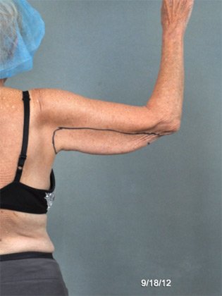 Female Patient Arm and Back Before Skin Tightening Treatment