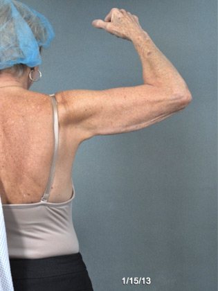 Female Patient Arm and Back After Skin Tightening Treatment