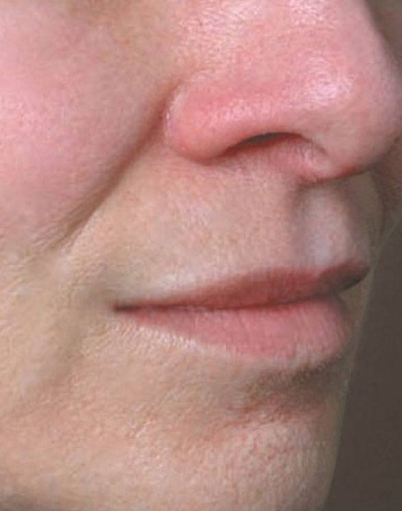 JUVEDERM VOLBELLA Patient's Mouth After Treatment