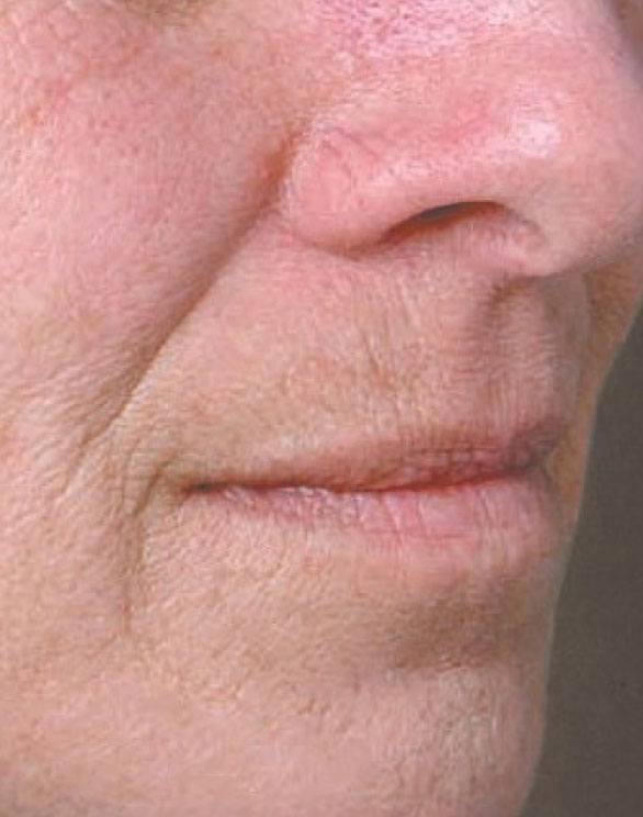 JUVEDERM VOLBELLA Patient's Mouth Before Treatment