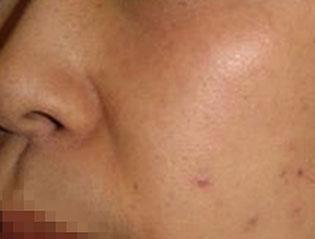 Reduced Pigmented Spots on Woman's Cheek After Treatment