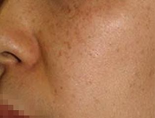 Pigmented Spots on Woman's Cheek