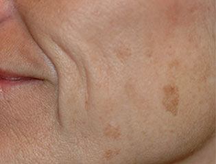 Brown Spots on Woman's Cheek