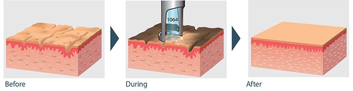 How Spectra Peel Works Under the Skin