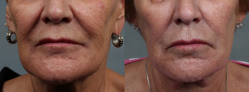 Older woman\'s lower face before and after microneedling